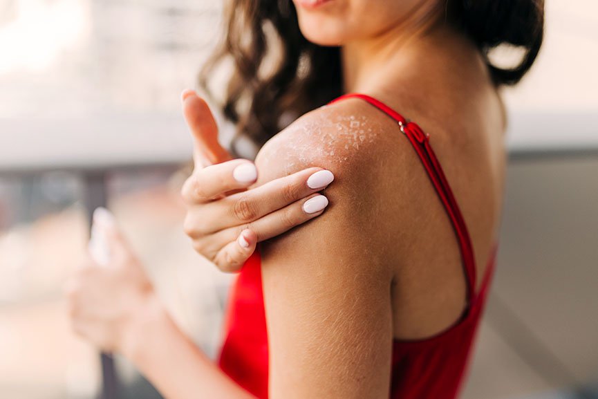¿Qué es la psoriasis?