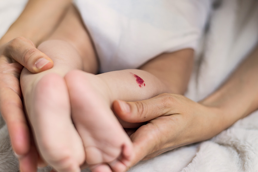 Hemangiomas-angiomas