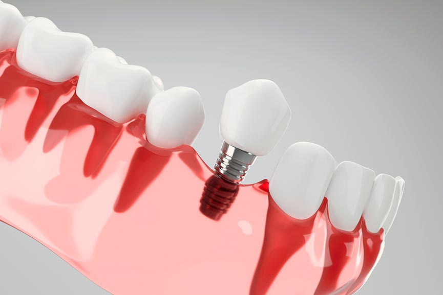 Implante dental